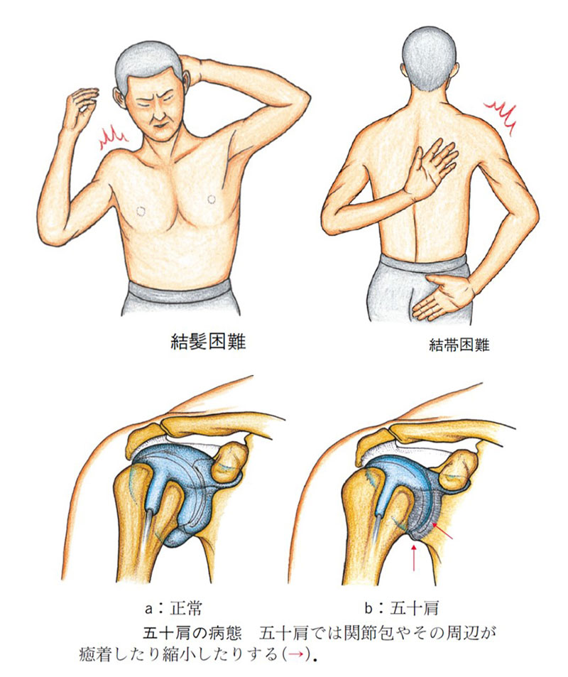 五十肩