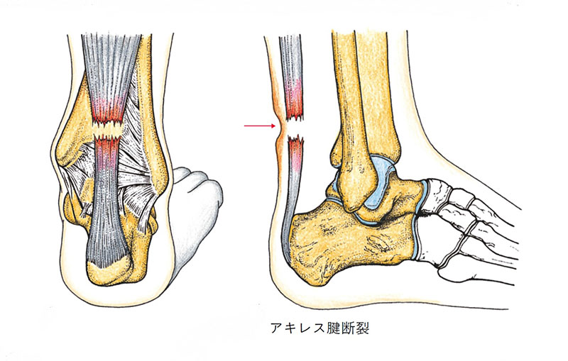 アキレス腱炎症・アキレス腱断裂