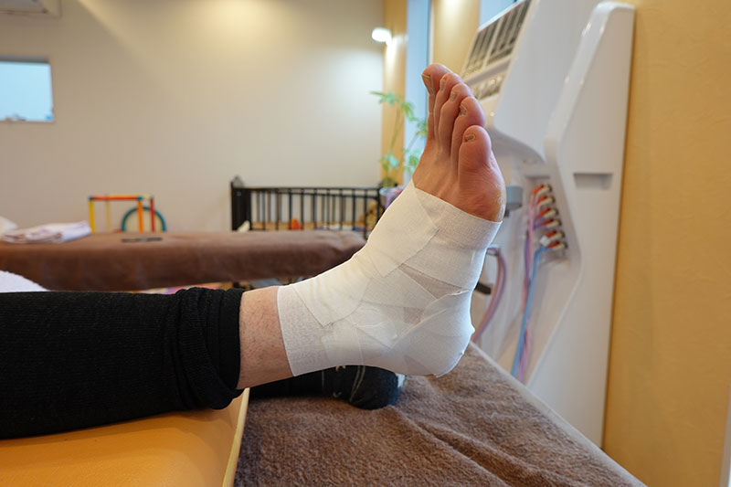 足関節捻挫に対するテーピング例
